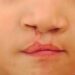 Día Mundial del Labio Leporino