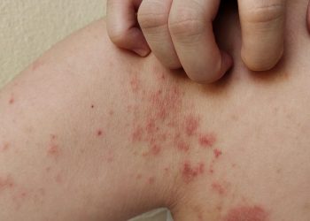 Síntomas de la Lepra-Morelia Informativo