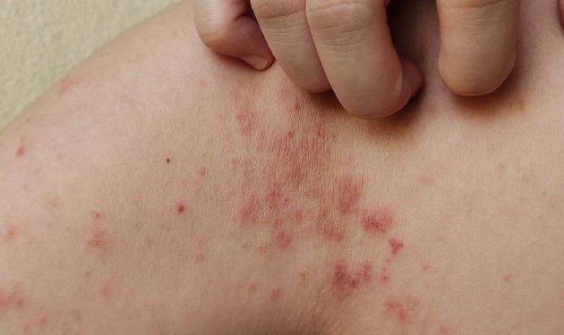 Síntomas de la Lepra-Morelia Informativo