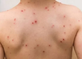 Mpox rebrote de viruela símica