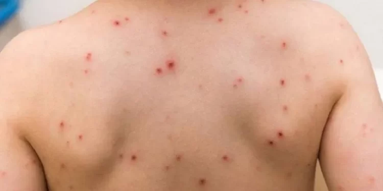 Mpox rebrote de viruela símica