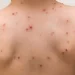 Mpox rebrote de viruela símica