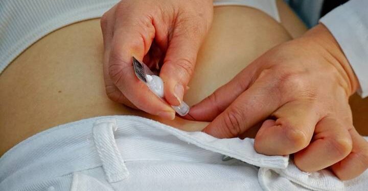 SSM implantes hormonales gratuitos