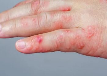 SSM te dice cómo evitar lesiones en la piel en temporada invernal