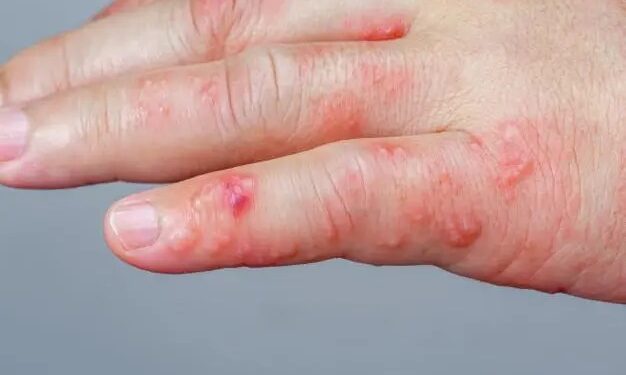 SSM te dice cómo evitar lesiones en la piel en temporada invernal