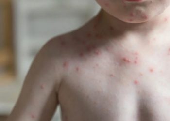 Confirma SSM primeros casos de sarampión en Michoacán