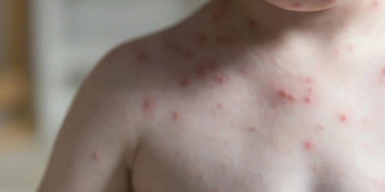 Confirma SSM primeros casos de sarampión en Michoacán