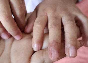 SSM descarta brote de virus de Coxsackie en la entidad