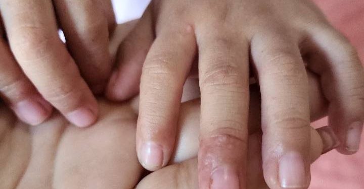SSM descarta brote de virus de Coxsackie en la entidad